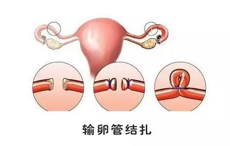 做复通手术没有成功，还能做试管婴儿吗？