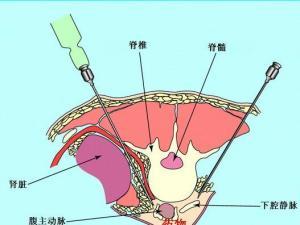 腹腔积液，去美国做试管婴儿成功率高吗？