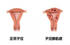 子宫腺肌症做美做试管婴儿成功率高吗？有没有影响？