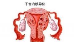 子宫内膜异位，美国试管助孕好孕率？