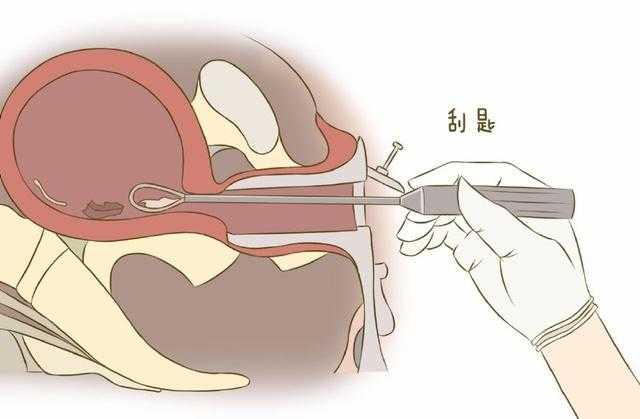 诺优笙国际：刮宫对试管成功率会有影响吗？